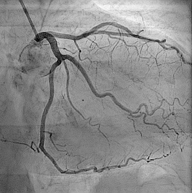 How is coronary angiogram done?  