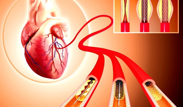 Coronary Angioplasty